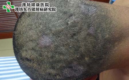 头部银屑病图,轻度头部银屑病症状