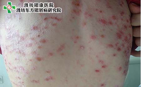 儿童银屑病症状,儿童得银屑病什么样