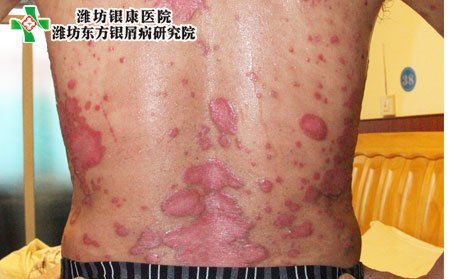 牛皮癣症状,牛皮癣扩散症状表现