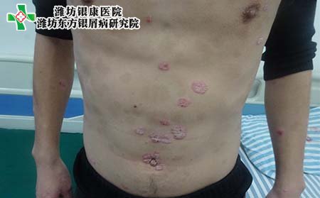 银屑病症状,早期银屑病症状