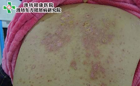 牛皮癣症状,初期牛皮癣的表现