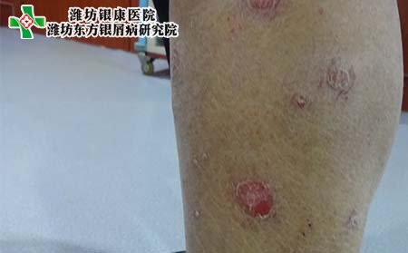 牛皮癣症状,寻常型牛皮癣症状