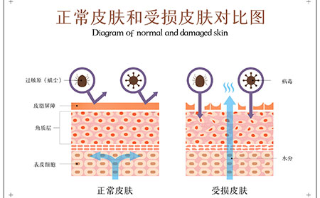 银屑病关节炎有哪几个类型