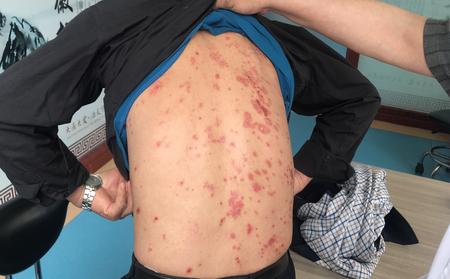潍坊有几家专业治疗银屑病的医院