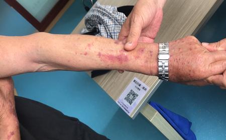 潍坊治疗银屑病医院哪家好