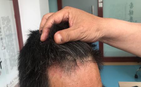潍坊看牛皮癣的医院哪家好