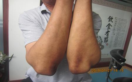 潍坊银屑病那家专科医院看得好