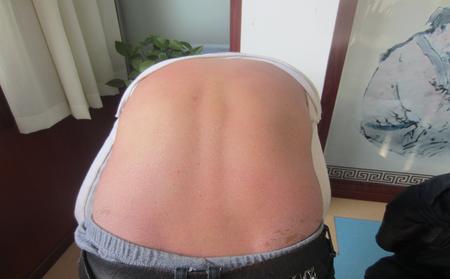 潍坊治疗银屑病一般需要多少钱